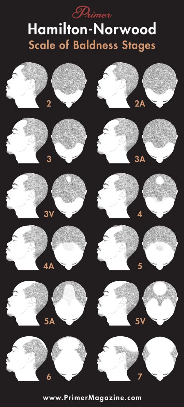 hamilton norwood baldness hair loss scale